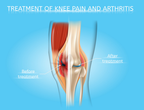 Knee Pain and Stem Cells
