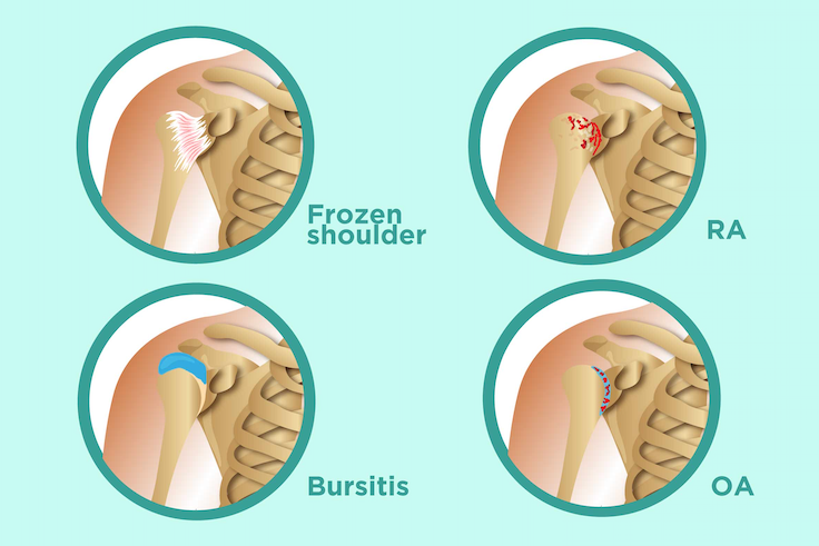shoulder pain conditions
