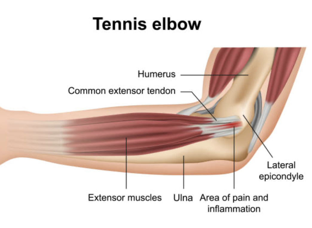 elbow pain from tennis elbow